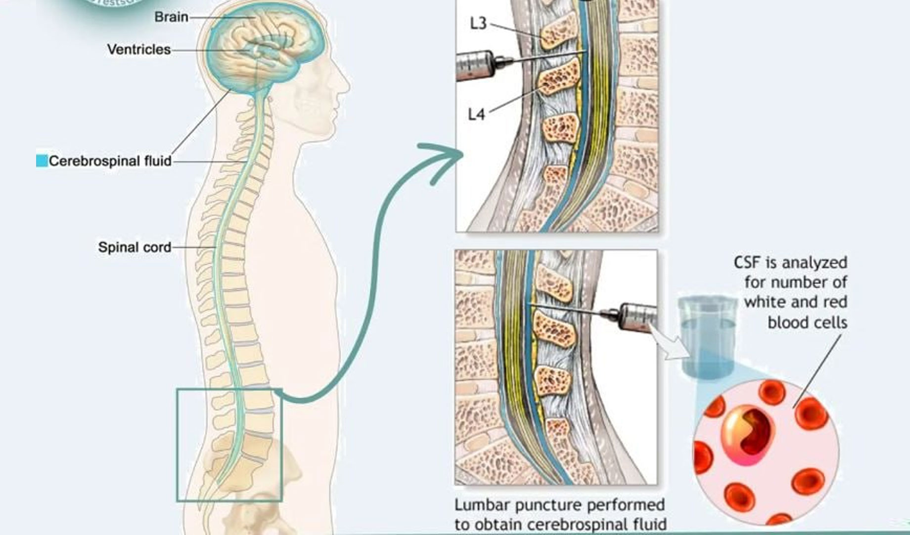 Normal cerebrospinal fluid - Cell Bio