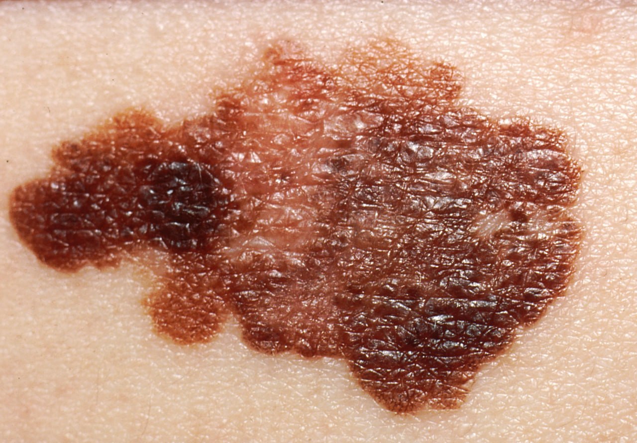 Advancing Melanoma Precision Medicine Through High-Quality Biospecimens
